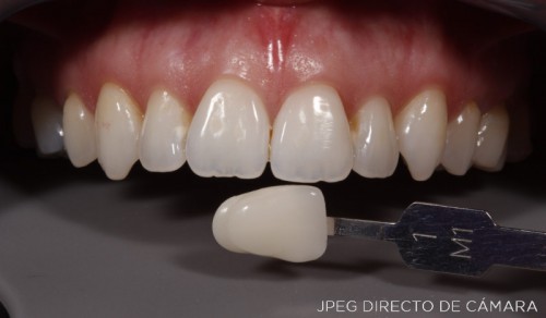 Foto dental 700D - Dentadura - JPG directo
