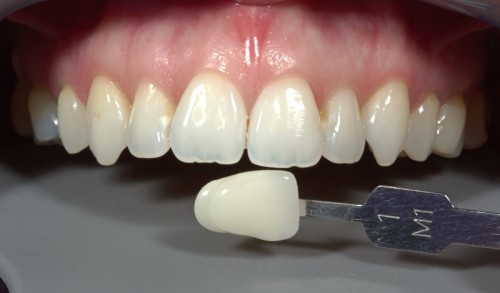 Fotografia de piezas y muestra dental